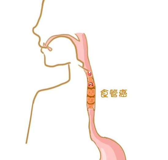 食管癌的症状概览